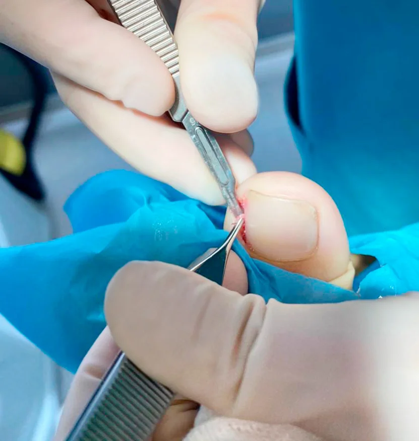 Cirugia Ungueal Sant Adria del besos